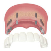 Zubní implantát